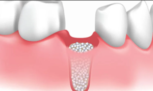 implantes dentales sin hueso