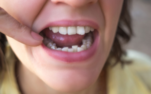 Tengo los dientes montados y no me gustan