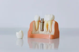 implantes dentales en madrid